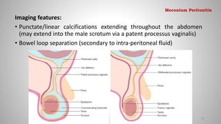 Imaging features:
• Punctate/linear calcifications extending throughout the abdomen
(may extend into the male scrotum via a patent processus vaginalis)
• Bowel loop separation (secondary to intra-peritoneal fluid)
93
Meconium Peritonitis
 