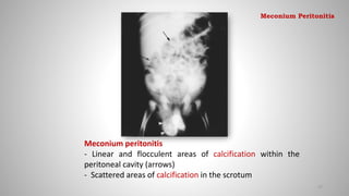 Meconium peritonitis
- Linear and flocculent areas of calcification within the
peritoneal cavity (arrows)
- Scattered areas of calcification in the scrotum
97
Meconium Peritonitis
 