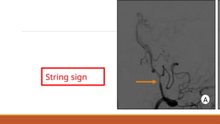 Pediatric ischemic stroke MANAGEMENT 3.pptx