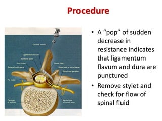Procedure
• A “pop” of sudden
decrease in
resistance indicates
that ligamentum
flavum and dura are
punctured
• Remove stylet and
check for flow of
spinal fluid
 