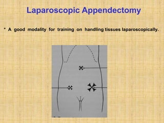 * A good modality for training on handling tissues laparoscopically.
Laparoscopic Appendectomy
 