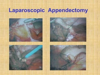 Laparoscopic Appendectomy
 