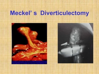 Meckel’ s Diverticulectomy
 