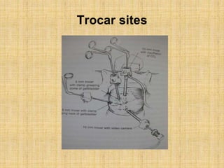 Trocar sites
 