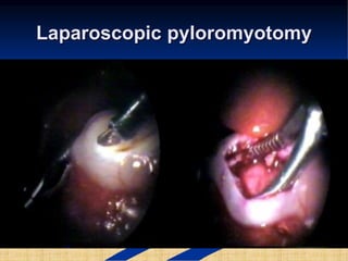 Laparoscopic pyloromyotomy
 
