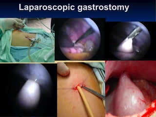 Laparoscopic gastrostomy
 