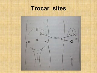 Trocar sites
 