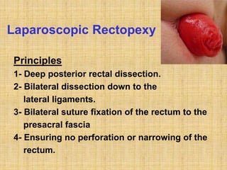 Laparoscopic Rectopexy
Principles
1- Deep posterior rectal dissection.
2- Bilateral dissection down to the
lateral ligaments.
3- Bilateral suture fixation of the rectum to the
presacral fascia
4- Ensuring no perforation or narrowing of the
rectum.
 