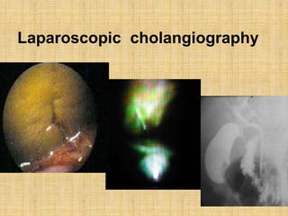 Laparoscopic cholangiography
 