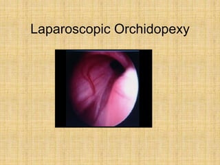 Laparoscopic Orchidopexy
 