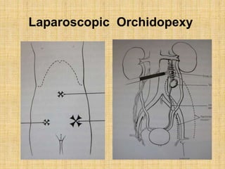 Laparoscopic Orchidopexy
 