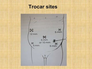 Trocar sites
 
