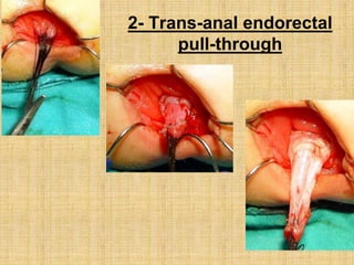 2- Trans-anal endorectal
pull-through
 