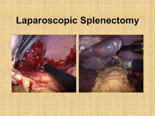Laparoscopic Splenectomy
 
