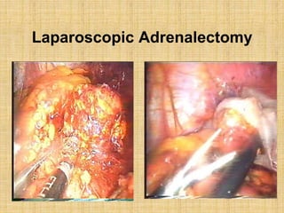 Laparoscopic Adrenalectomy
 