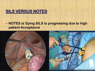  NOTES is Dying SILS is progressing due to high
patient Acceptance
 