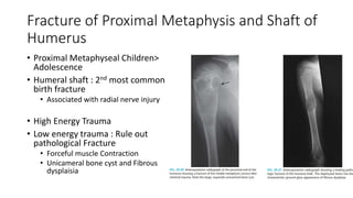 Fracture of Proximal Metaphysis and Shaft of
Humerus
• Proximal Metaphyseal Children>
Adolescence
• Humeral shaft : 2nd most common
birth fracture
• Associated with radial nerve injury
• High Energy Trauma
• Low energy trauma : Rule out
pathological Fracture
• Forceful muscle Contraction
• Unicameral bone cyst and Fibrous
dysplaisia
 