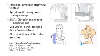 • Proximal Humeral metaphyseal
fracture
• Symptomatic management
• Sling is enough
• Shaft : Closed management
• Coaptation split
• 2-3 weeks : Sling / Hanging
Cast / Fracture Brace
• Circumduction and Pendular
exercises
 