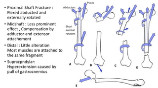• Proximal Shaft Fracture :
Flexed abducted and
externally rotated
• Midshaft : Less prominent
effect , Compensation by
adductor and extensor
attachement
• Distal : Little alteration
Most muscles are attached to
the same fragment
• Supracpndylar:
Hyperextension caused by
pull of gastrocnemius
Short
exernal
rotators
Psoas
Abductors
 