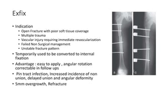 Exfix
• Indication
• Open Fracture with poor soft tissue coverage
• Multiple trauma
• Vascular injury requiring immediate revascularization
• Failed Non Surgical management
• Unstable fracture pattern
• Temporarily used to be converted to internal
fixation
• Advantage : easy to apply , angular rotation
correctable in follow ups
• Pin tract infection, Increased incidence of non
union, delayed union and angular deformity
• 5mm overgrowth, Refracture
 