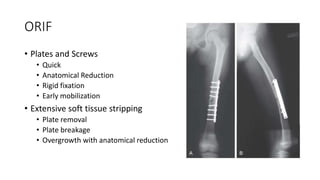 ORIF
• Plates and Screws
• Quick
• Anatomical Reduction
• Rigid fixation
• Early mobilization
• Extensive soft tissue stripping
• Plate removal
• Plate breakage
• Overgrowth with anatomical reduction
 