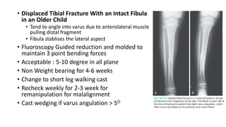 • Displaced Tibial Fracture With an Intact Fibula
in an Older Child
• Tend to angle into varus due to anterolateral muscle
pulling distal fragment
• Fibula stablises the lateral aspect
• Fluoroscopy Guided reduction and molded to
maintain 3 point bending forces
• Acceptable : 5-10 degree in all plane
• Non Weight bearing for 4-6 weeks
• Change to short leg walking cast
• Recheck weekly for 2-3 week for
remanipulation for malalignment
• Cast wedging if varus angulation > 5O
 