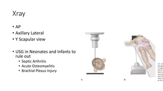 Xray
• AP
• Axillary Lateral
• Y Scapular view
• USG in Neonates and Infants to
rule out
• Septic Arthritis
• Acute Osteomyelitis
• Brachial Plexus Injury
 