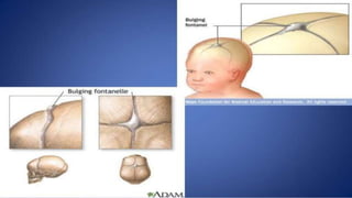 pediatric meningitis.pptx