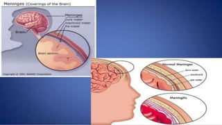 pediatric meningitis.pptx