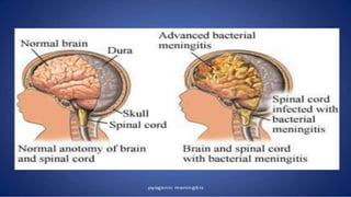 pediatric meningitis.pptx