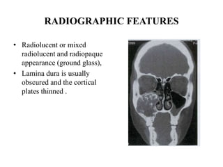 Glass Radiograph Pediatric neoplasm affecting the oral cavity | PPTX