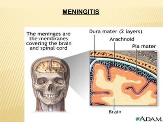 MENINGITIS

 