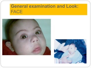 General examination and Look:
FACE
 