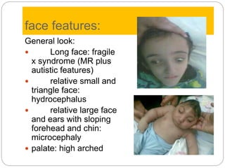 face features:
General look:
 Long face: fragile
x syndrome (MR plus
autistic features)
 relative small and
triangle face:
hydrocephalus
 relative large face
and ears with sloping
forehead and chin:
microcephaly
 palate: high arched
 