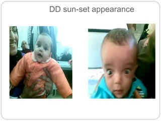 DD sun-set appearance
 