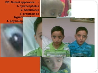 •DD: Sunset apperance:
1- hydrocephalus
2- Kernicterus
3- proptosis as
hyperthyroidism
4- physiological? familial
 