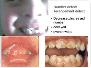 Number defect
Arrangement defect
 Decreased/Increased
number
 decayed
 overcrowded
 