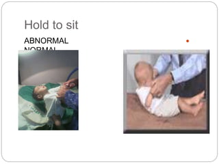 Hold to sit
ABNORMAL
NORMAL
 