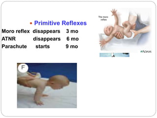  Primitive Reflexes
Moro reflex disappears 3 mo
ATNR disappears 6 mo
Parachute starts 9 mo
 