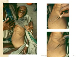 Severe wasting
10/28/2023 36
 