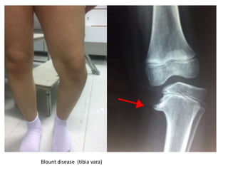 Blount disease (tibia vara)
 