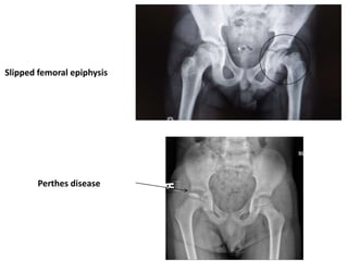 Slipped femoral epiphysis
Perthes disease
 
