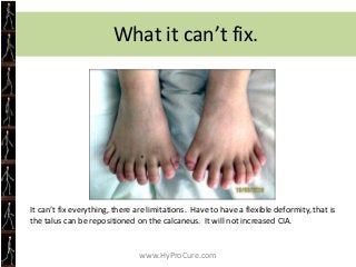 Radiographic Evaluation AP view
                   • Talar 2nd metatarsal angle
                     should be < 16 degree...