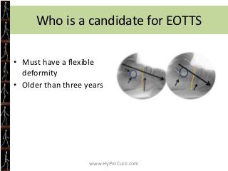 Pes PlanoValgus versus TaloTarsal Dislocation

    CIA* is flat to negative               CIA is normal to increased




 ...