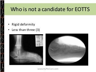 Treatment Options
•   Observation
•   Arch supports/orthoses
•   Special shoes or braces
•   Rearfoot reconstruction surge...