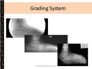 Obesity Treatment

• Decreased food intake
  is only part of the
  equation
• We have to get these
  kids moving
• This in...