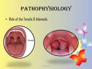 Pathophysiology
• Role of the Tonsils & Adenoids

11/22/2013

journal club

12

 