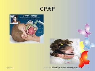 CPAP

11/22/2013

journal club Bilevel

positive airway pressure

35

 