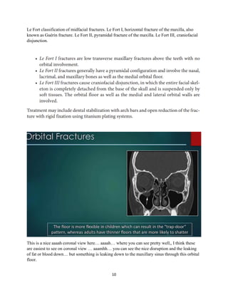 10
Le Fort classification of midfacial fractures. Le Fort I, horizontal fracture of the maxilla, also
known as Guérin fracture. Le Fort II, pyramidal fracture of the maxilla. Le Fort III, craniofacial
disjunction.
This is a nice aaaah coronal view here… aaaah… where you can see pretty well,, I think these
are easiest to see on coronal view … aaamhh… you can see the nice disruption and the leaking
of fat or blood down… but something is leaking down to the maxillary sinus through this orbital
floor.
 