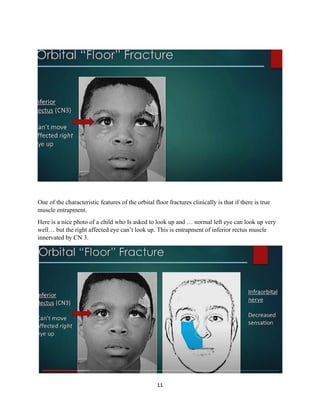 11
One of the characteristic features of the orbital floor fractures clinically is that if there is true
muscle entrapment.
Here is a nice photo of a child who Is asked to look up and … normal left eye can look up very
well… but the right affected eye can’t look up. This is entrapment of inferior rectus muscle
innervated by CN 3.
 